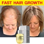 PURC-Fast-Hair-Growth-Serum-Oil-for-Men-Women-Ginger-Anti-Hair-Loss-Scalp-Treatment-Grow